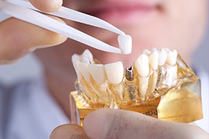 Model smile with implant dental crown