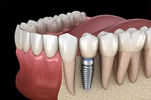 Animation of implant supported dental crown