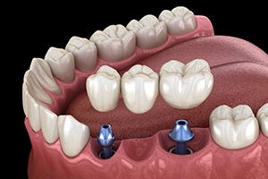 Animation of implant supported fixed bridge