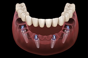 Animation of implant supported fixed bridge