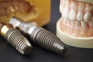 Model smile and dental implants