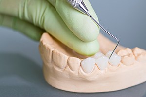 Model smile with fixed bridge restoration