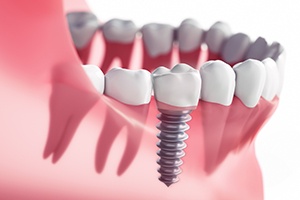 Animation of implant supported dental crown