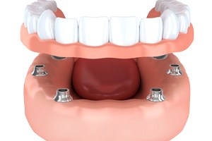 implant-retained full dentures