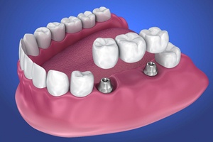 implant-retained bridge