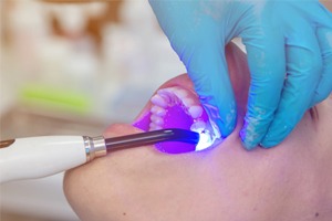 A curing light being used on a patient