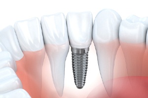 single dental implant