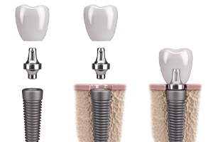 parts of dental implant